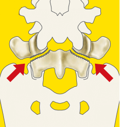 腰椎が２つに分離する状態を説明するイラスト