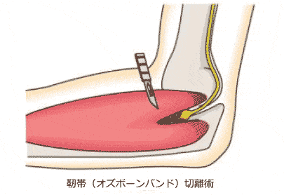 靭帯（オズボーンバンド）切離術のイラスト