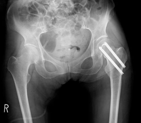 頚部骨折ステージⅠ・Ⅱの骨接合術、手術後レントゲン
