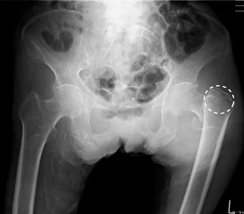 転子部骨折の髄内釘固定術、手術前レントゲン