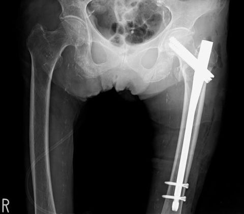 転子部骨折の髄内釘固定術、手術後レントゲン