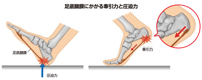 足底腱膜にかかる牽引力と圧迫力のイラスト