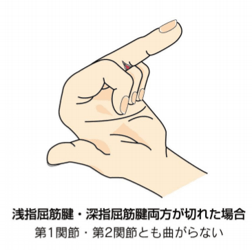 深指屈筋腱と浅指屈筋腱両方切れた場合の指の曲がり方のイラスト