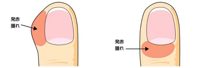 爪の周囲が赤く腫れるなどの炎症・化膿が生じた状態のイラスト
