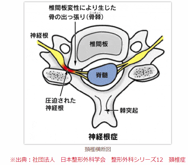 神経根症のイラスト