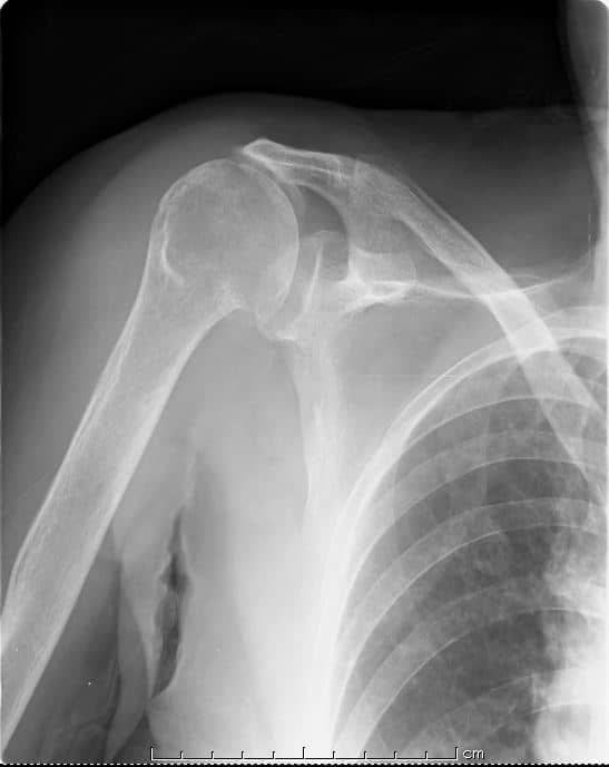 リバース型人工肩関節全置換術の手術前のレントゲン