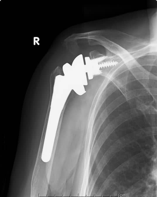 リバース型人工肩関節全置換術の手術後のレントゲン