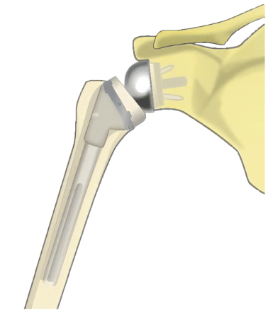 リバース型（反転型）人工肩関節全置換術のイラスト