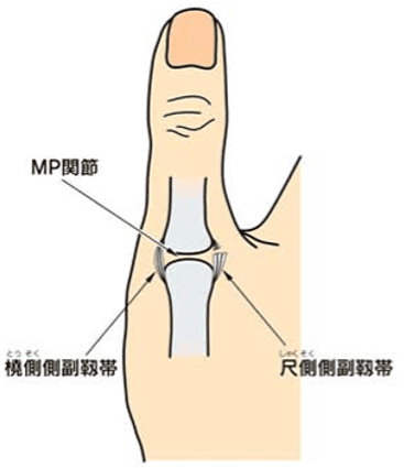 母指MP関節靭帯損傷のイラスト