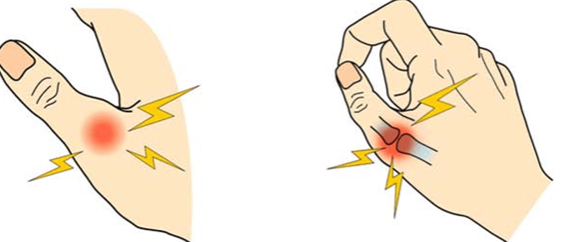 母指MP関節靭帯損傷の症状のイラスト