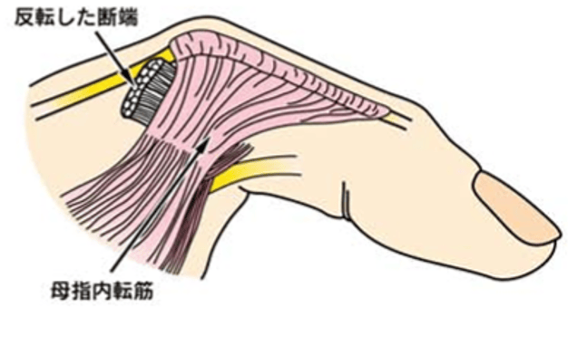 母指MP関節靭帯損傷で、靭帯が完全に断裂し反転して引っかかっているケースのイラスト