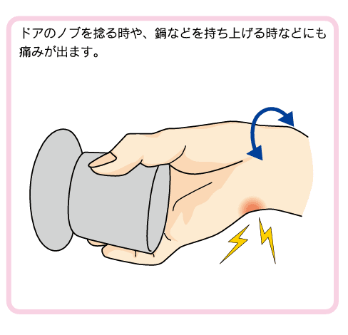 TFCCでドアノブを回す時の痛みのイラスト