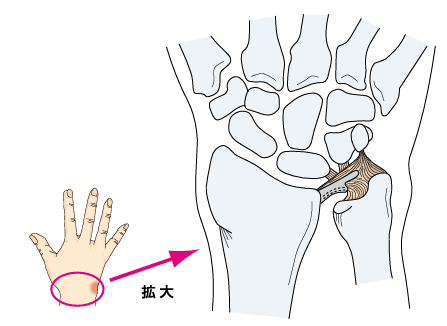 TFCCが損傷した状態のイラスト