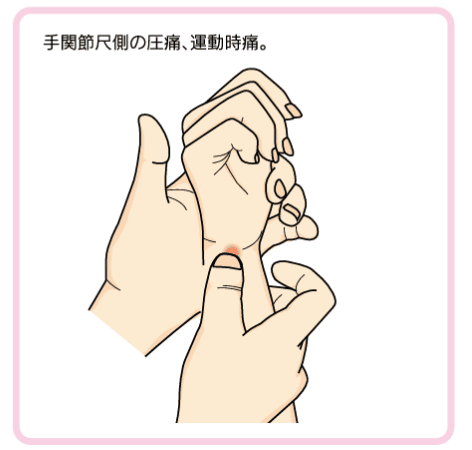 TFCCで手関節尺側の圧痛のイラスト