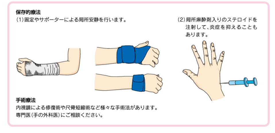 TFCCでの保存療法のイラスト