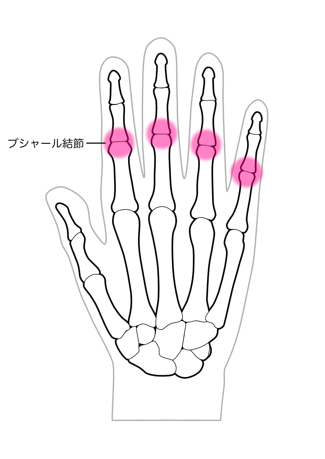 ブシャール結節のイラスト