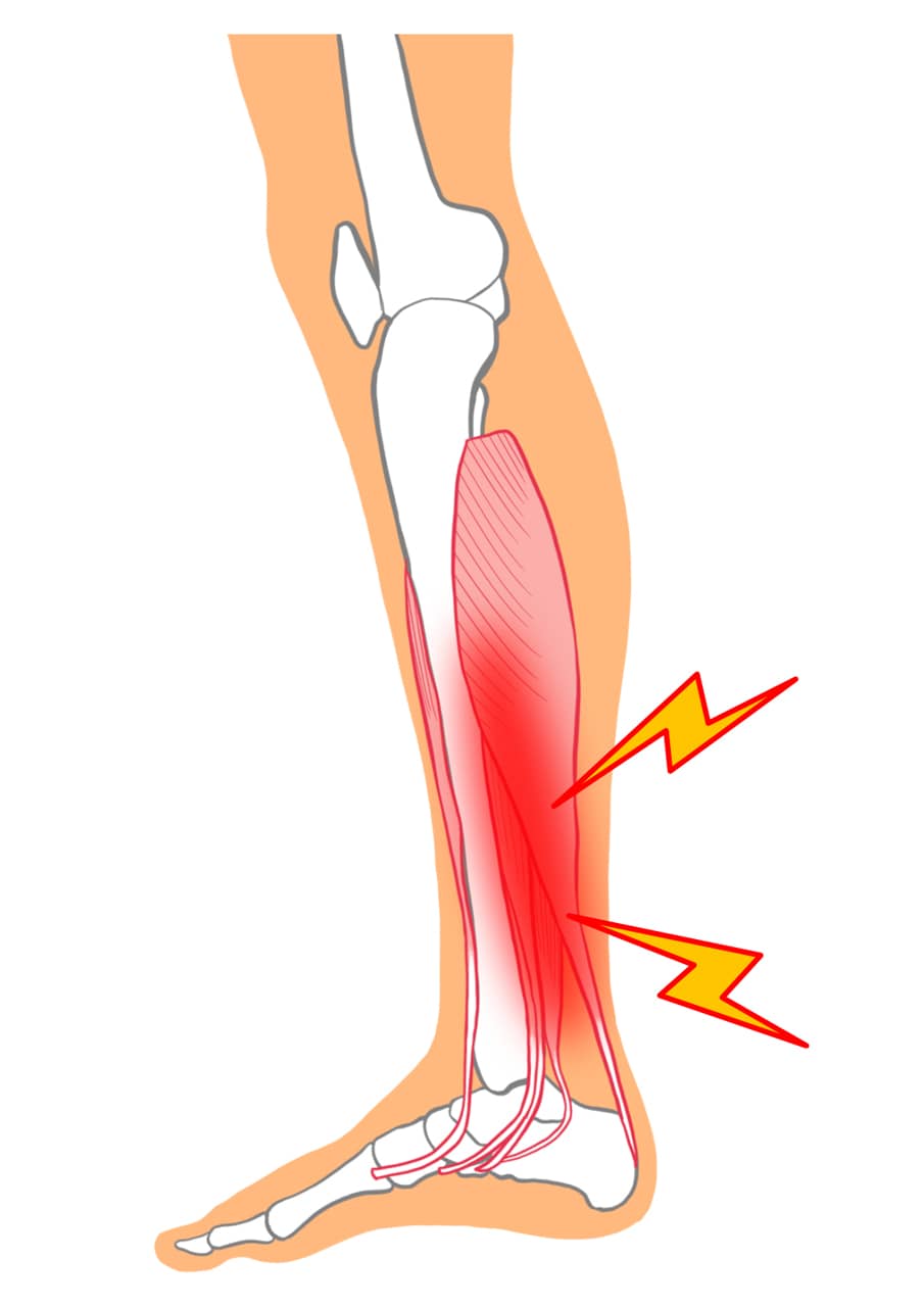 脛骨の内側縁の、中央から足首に近い部分（下1/3あたり）で鈍い痛みが広範囲に発生する骨と筋肉のイラスト