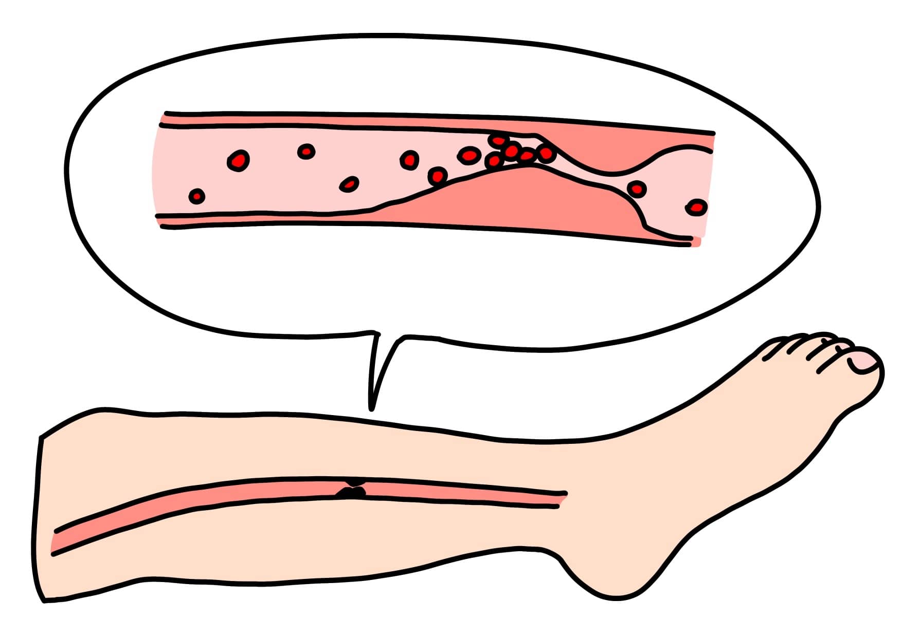 動脈硬化によって足の血管が狭くなった様子のイラスト