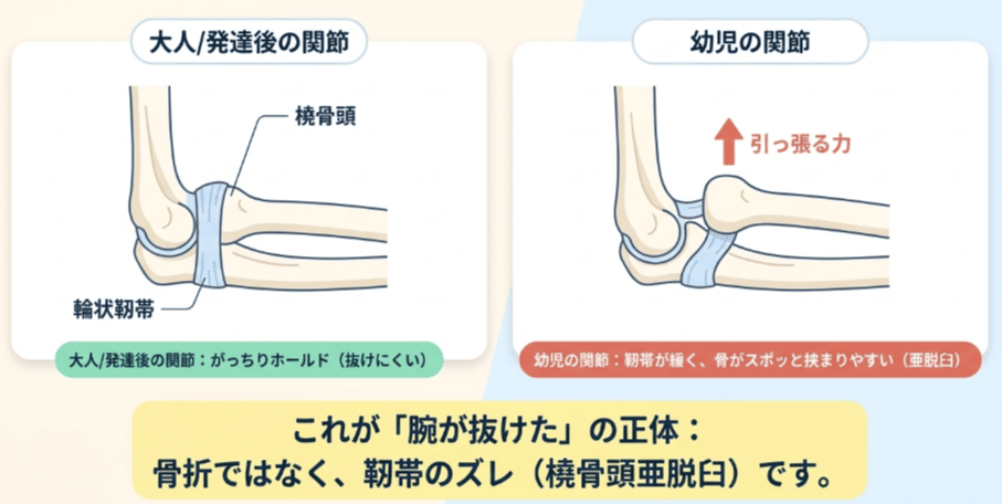 肘内障のイラスト