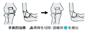 変形性肘関節症の手術療法のイラスト