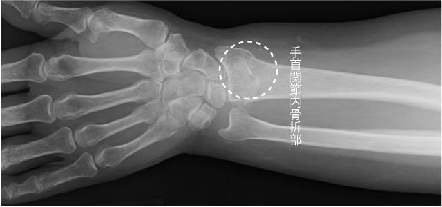 撓骨遠位端骨折、手術前の手首内骨折部のレントゲン