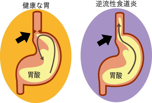 健康な胃と、逆流性食道炎の胃のイラスト