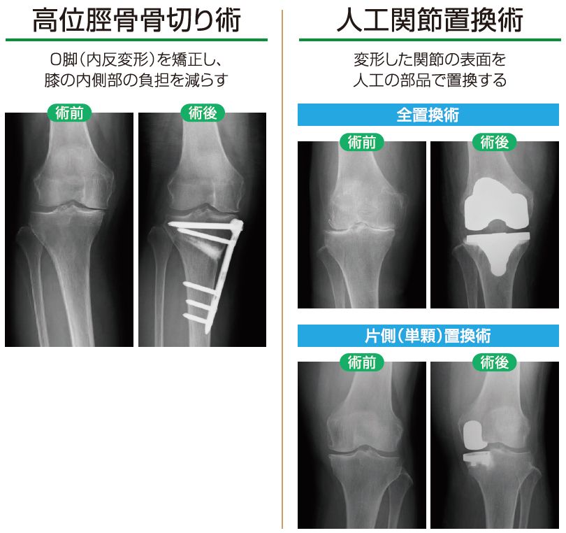 高位脛骨骨切り術と人工関節置換術の術前・術後レントゲン
