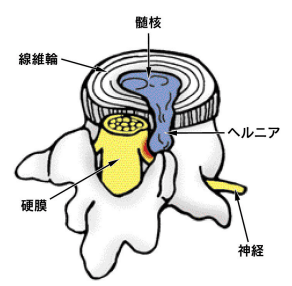 腰椎椎間板ヘルニアの状態を説明するイラスト