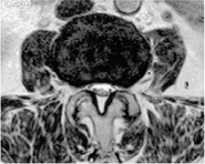 正常な脊椎のMRI（横断像）