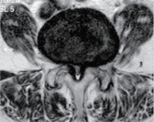 腰部脊柱管狭窄症のMRI（横断像）