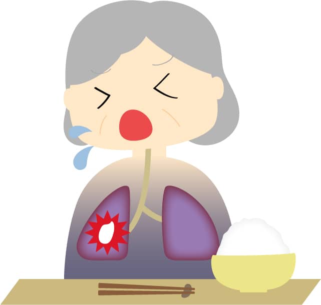 誤嚥性肺炎で、肺に食事が入ってしまう老人のイラスト