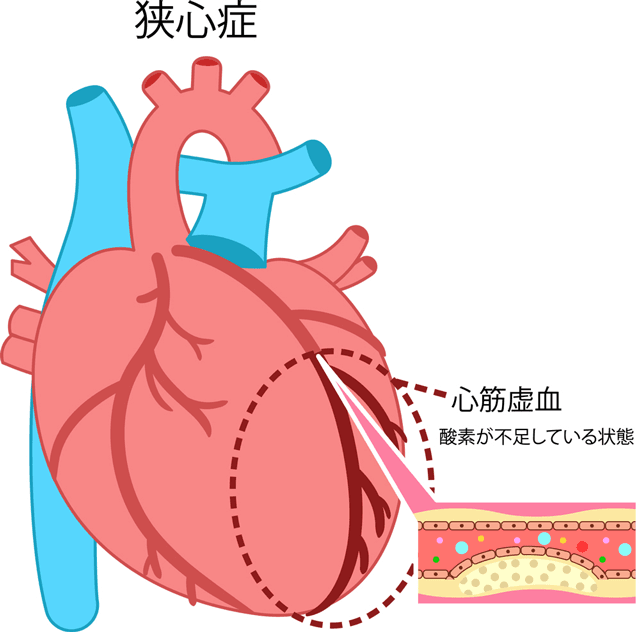 狭心症を説明する心臓のイラスト