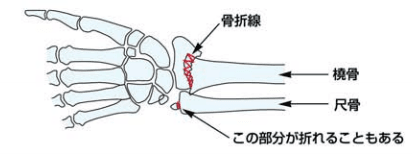 橈骨遠位端骨折のイラスト
