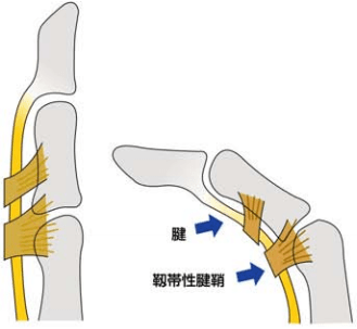 指の屈筋腱と靭帯性腱鞘のイラスト