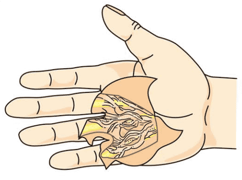 デュピュイトラン拘縮で、皮下にある線維性の手掌腱膜に体内で産生されたコラーゲンが異常に沈着してできた太い束（拘縮索）のイラスト