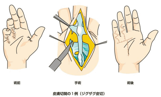 デュピュイトラン拘縮で、皮下にある線維性の手掌腱膜に体内で産生されたコラーゲンが異常に沈着してできた太い束（拘縮索）のイラスト