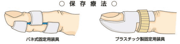 腱性マレット指の保存的療法のイラスト