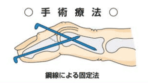 骨性マレット指の手術療法である銅線による固定法のイラスト
