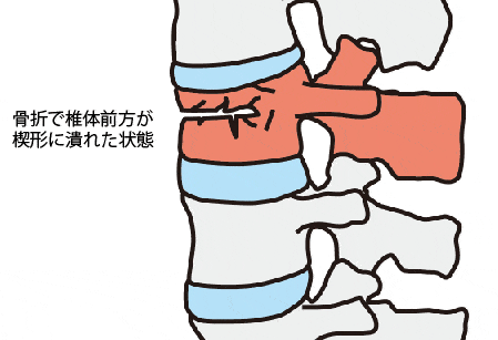 骨折で椎体前方が楔形に潰れた状態のイラスト